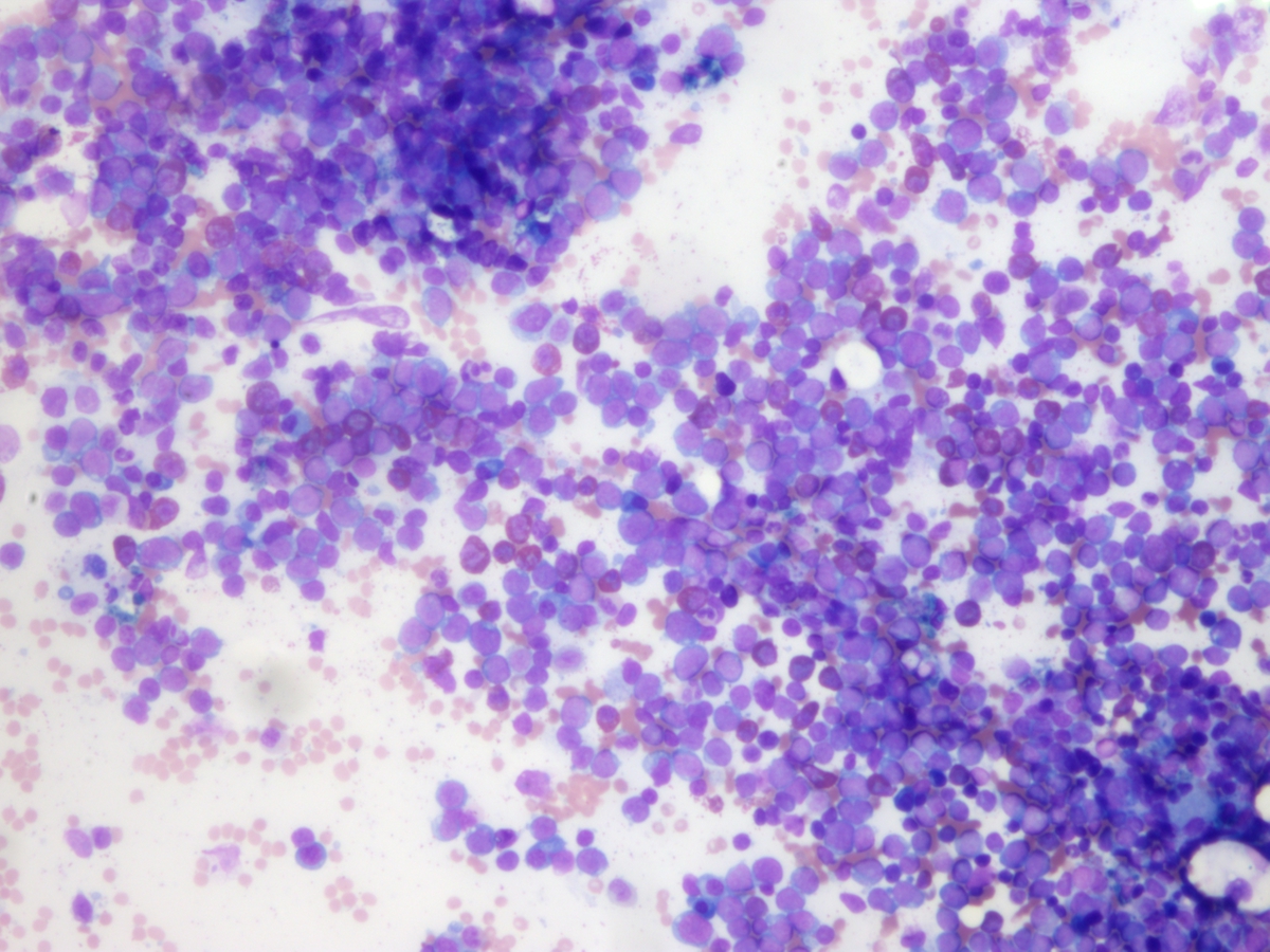 Initial bone marrow aspirate 10x